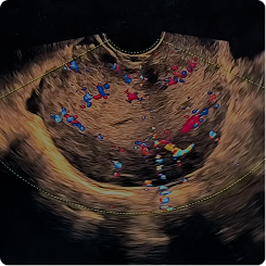 Menorrhagia