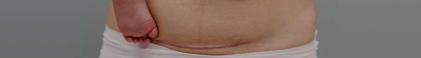 C-Sections